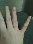 Повреждение пальца руки, шишка фото 1
