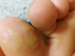 Водянистые пузыри, похожие на бородавки на пальцах ног около месяца фото 1