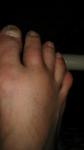 Опух указательный палец на ноге фото 1