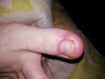 Воспаление на пальце, болит фото 1