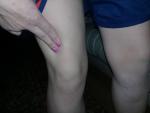 Боль над коленом при напряжении фото 1
