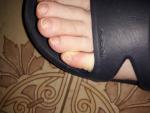 Мягкие и слоящиеся ногти на мизинцах ног фото 1