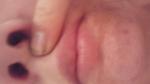 Рак верхней губы фото 2