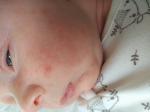 Высыпания на лице новорожденного фото 1