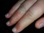 Аллергия на пальцах рук фото 1