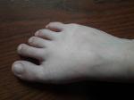 Боль у омнования пальцеа ног и больших пальцев фото 1