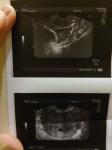 Эмбрион и жидкость фото 1