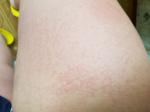 Аллергические дерматоз на ногах фото 2