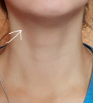 Увеличен лимфоузел в горле, горло не болит, белый налет фото 5