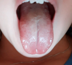 Увеличен лимфоузел в горле, горло не болит, белый налет фото 4