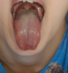 Увеличен лимфоузел в горле, горло не болит, белый налет фото 3