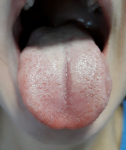 Увеличен лимфоузел в горле, горло не болит, белый налет фото 2