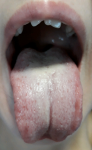 Увеличен лимфоузел в горле, горло не болит, белый налет фото 1