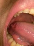 Болит горло, наросты на языке и температура длительное время фото 1