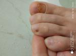Темное пятно на ногте ноги фото 1