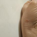 После укуса блохи, неизвестное пятно на руке фото 1