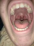 Проблемы с горлом танзилит фото 1