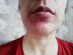 Аллергический дерматит, высыпания вокруг рта фото 1