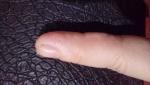 Пузыри мелкие на пальце рук фото 1