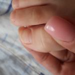 Ямки на ногтях у ребёнка фото 1