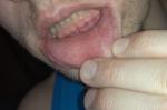 Слизистая на нижней губе рта фото 3