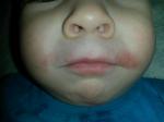 Покраснения вокруг рта у ребёнка фото 1