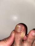 Черные пятна на ногте ноги фото 1