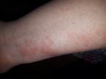 Аллергический дерматит, зуд, краснота фото 1