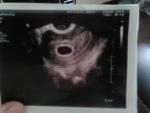 Анаэмбриония или есть шанс? фото 1