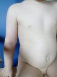Сыпь у ребёнка без температуры фото 1
