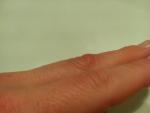 Болит кожа на среднем пальце руки фото 3