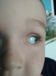 Пузырек на белке глаза у ребенка фото 1