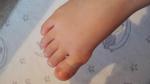 Шишка возле большого пальца ноги у ребенка 2,3 года фото 1