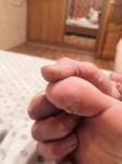 Болячки на пальцах ног фото 2