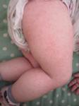 Сыпь на коже у ребёнка 9 месяцев фото 1