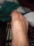 Нарост или шишка на пальце ноги фото 2