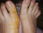 Болит первый палец на левой ноге после пробежки фото 2