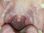 Хроническая ангина, ком в горле фото 2