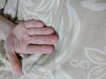 Слезает кожа с пальцев рук у ребёнка 10 лет фото 1