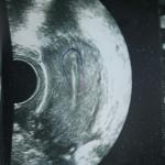 Замершая беременность, осложнения после вакумной аспирации фото 1