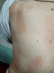 Что это алергия или дерматит фото 1