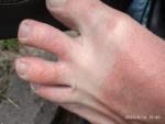 Сыпь на пальцах рук и ног в виде волдырей фото 1