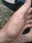 Сыпь на пальцах рук и ног в виде волдырей фото 2