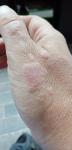 Воспаление кожи на руках фото 2
