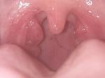 Боль в горле, увеличенная миндалина фото 1