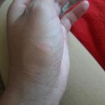 Сухое выпуклое пятно на руке фото 2