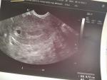 Анализ УЗИ, беременность фото 1