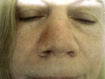 Киста крыла носа после травмы фото 1