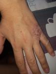 Рана на левой руке, трещина и кровит фото 2