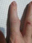 Шишка на суставе пальце после пореза фото 1